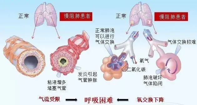 逆转慢阻肺最新技术，重塑呼吸自由新篇章